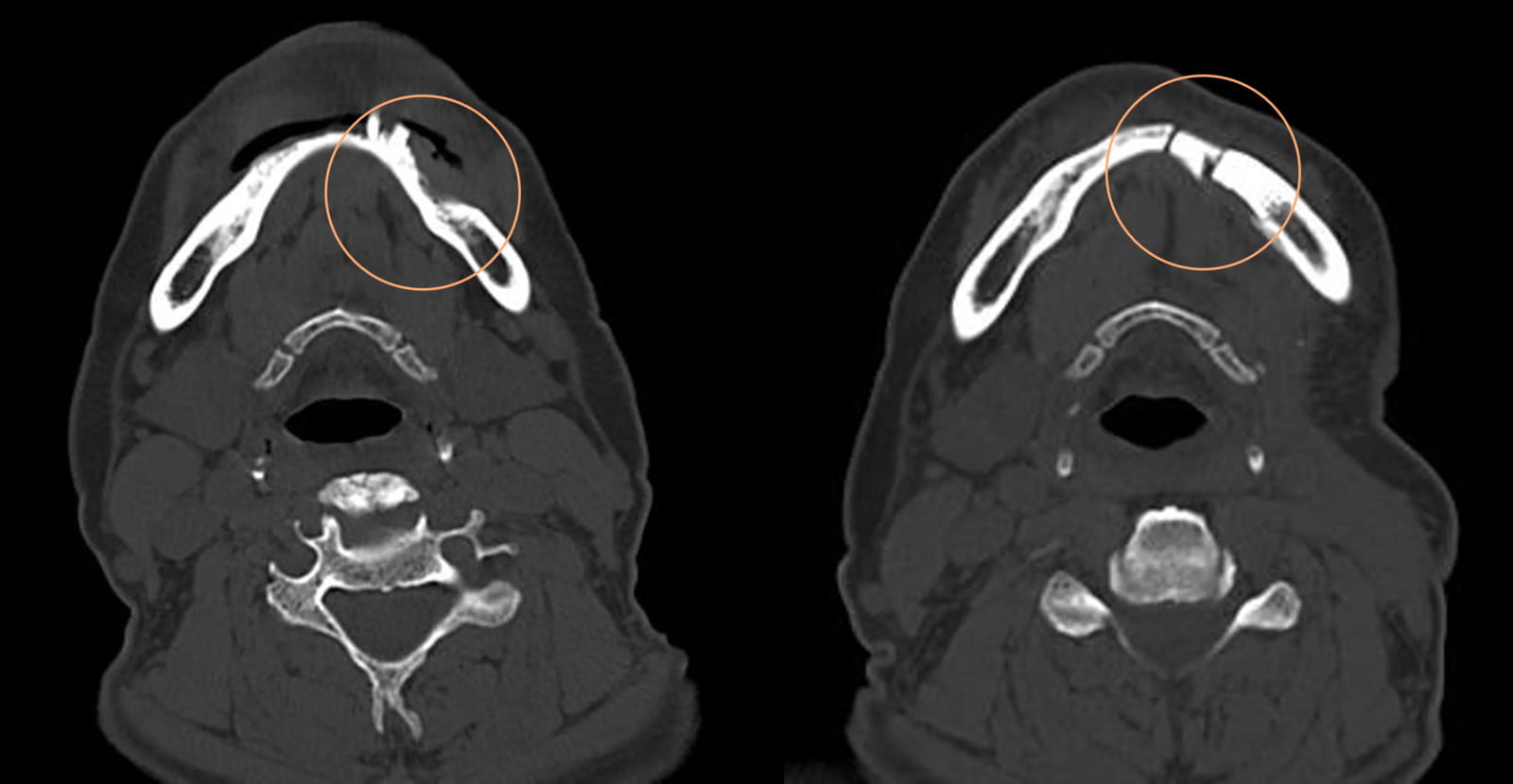 Segmental Mandible Reconstruction