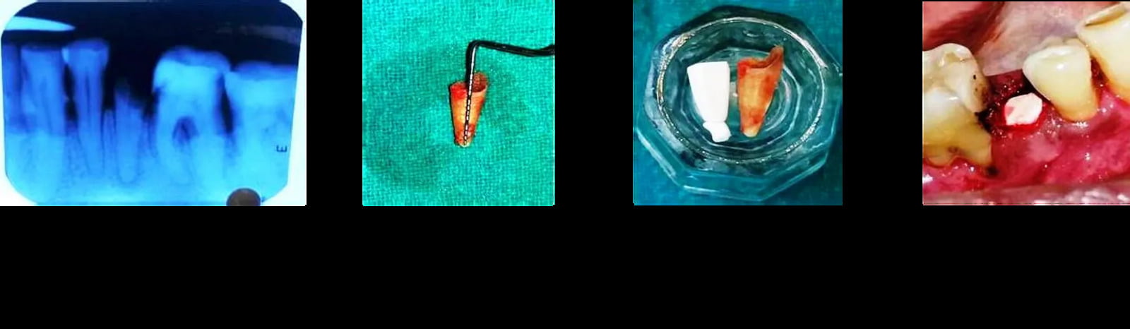 Periodontal Defect Reconstruction