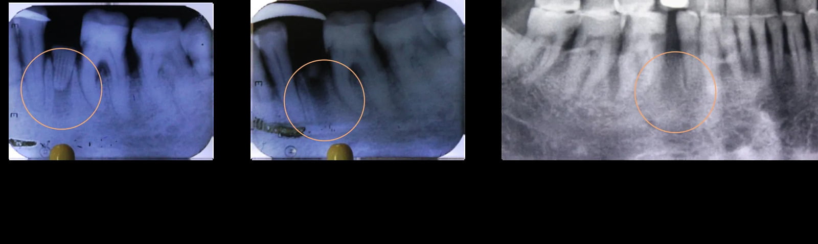 Periodontal Defect Reconstruction