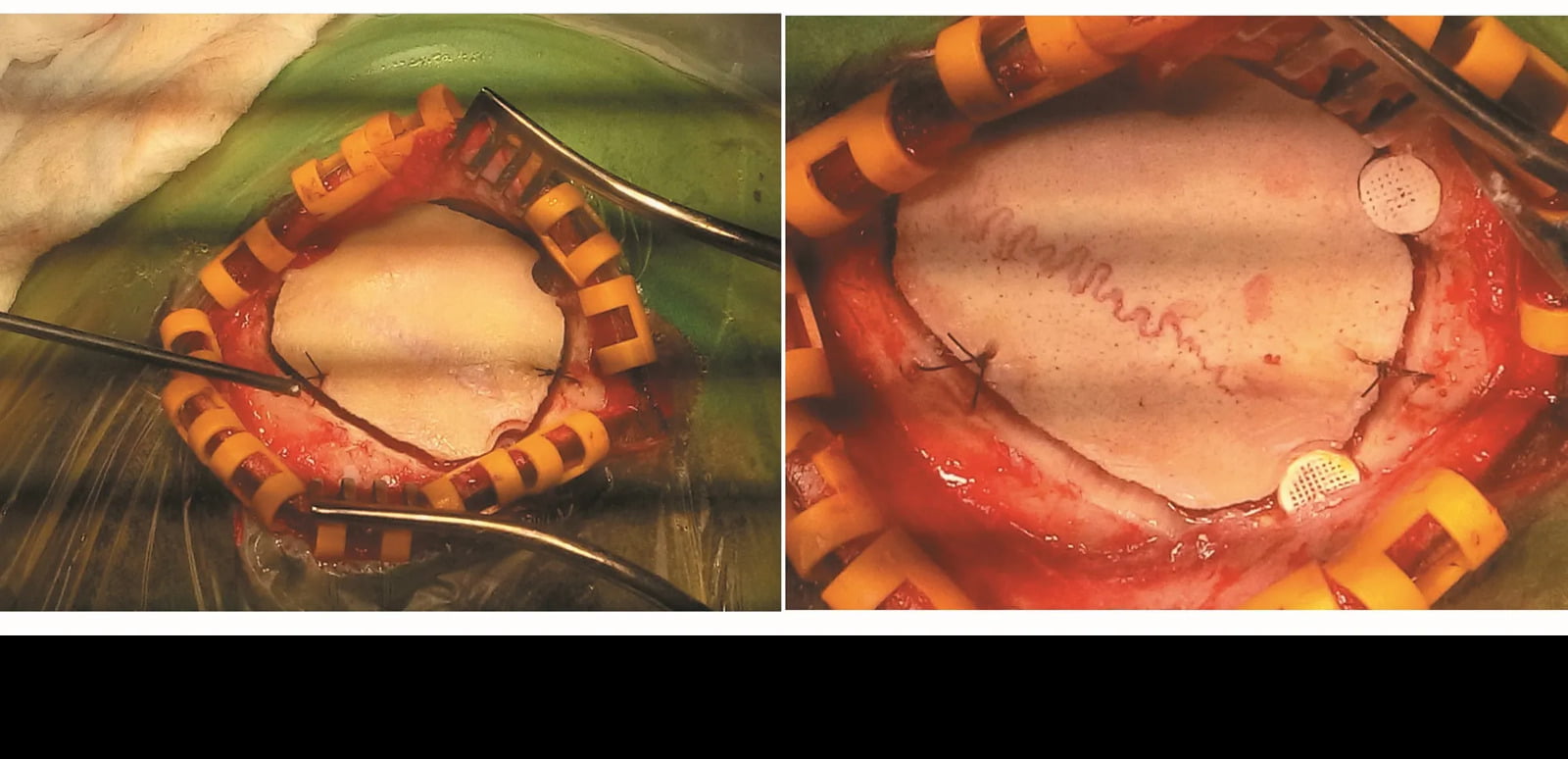 Cranial Burr Hole Defect Reconstruction
